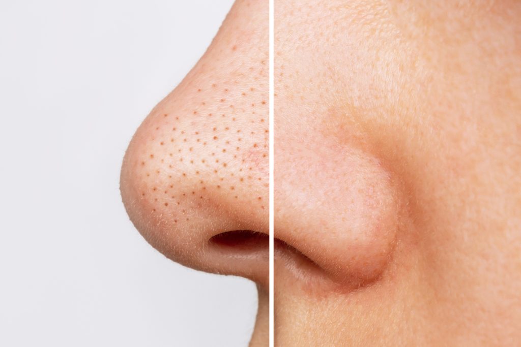 closeup womans nose with blackheads black dots before after peeling cleansing face