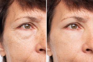 two shots elderly woman face with puffiness her eyes wrinkles before after treatment