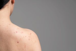 young woman showing acne her shoulders