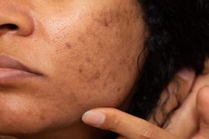 closeup asian woman with dark spots freckles problems