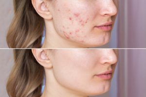 cropped shot young woman s face before after acne treatment face z