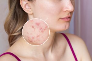 cropped shot young womans face with acne skin zoom circle pimples red scars rash cheeks