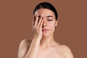 portrait young woman being confident with her acne