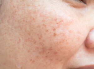 freckles freckles face