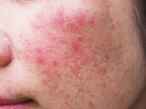 red rash young woman face itchy allergic skin problems dermatitis