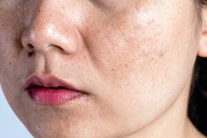 woman with problematic skin acne scars wrinkles dark spots