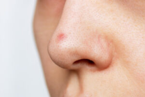 closeup womans nose with blackheads black dots red inflamed pimple acne problem