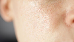 kin texture unhealthy with enlarged pores rosacea red rashes allergic redness