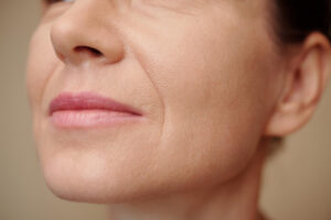 woman with nasolabial folds