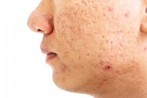 close up problematic skin with deep acne scars cheek men pigmentation 1