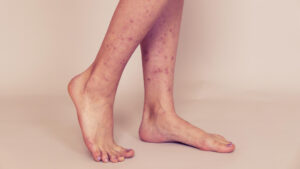 female legs with many red spot scar insect bites legs