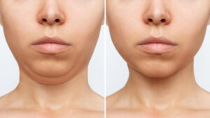 liposuction double chin woman s face with chin before after cosmetic plastic surgery