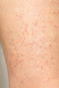 macro skin with folliculitis closeup woman hair with irritation hair bulbs localized redness with pinpoint spots