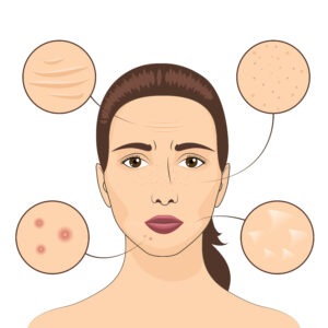 13381320 1701.m00.i125.n001.P.c25.416980738 Woman skin problem vector illustration. Female face with skins problematic areas