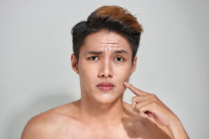 attractive youthful naked male with trouble skin