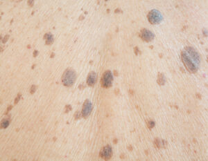freckles skin