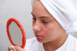 sad teenage girl is looking pimples her face mirror problematic skin adolescents acne