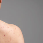young woman showing acne her shoulders 1