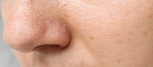 acne pimples nose closeup problematic facial skin poor hygiene