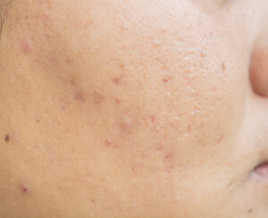 scar from acne face skin problems pores teenagers