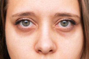 womans eyes with dark circles eyes with red capillaries