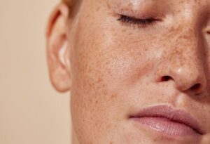 freckles on face 3 f0a952981f