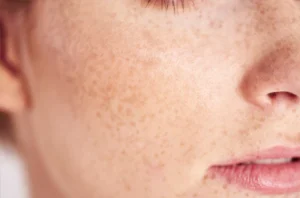 Skin Pigmentation Freckles Dermatology 480x480