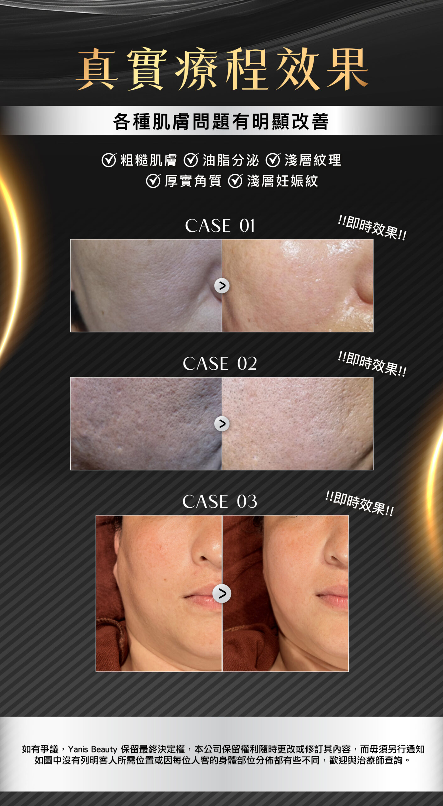 YB Web ALLTIMO黑金鈦提升 06 scaled